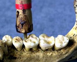 Dentiştii preistorici utilizau tehnici sofisticate
