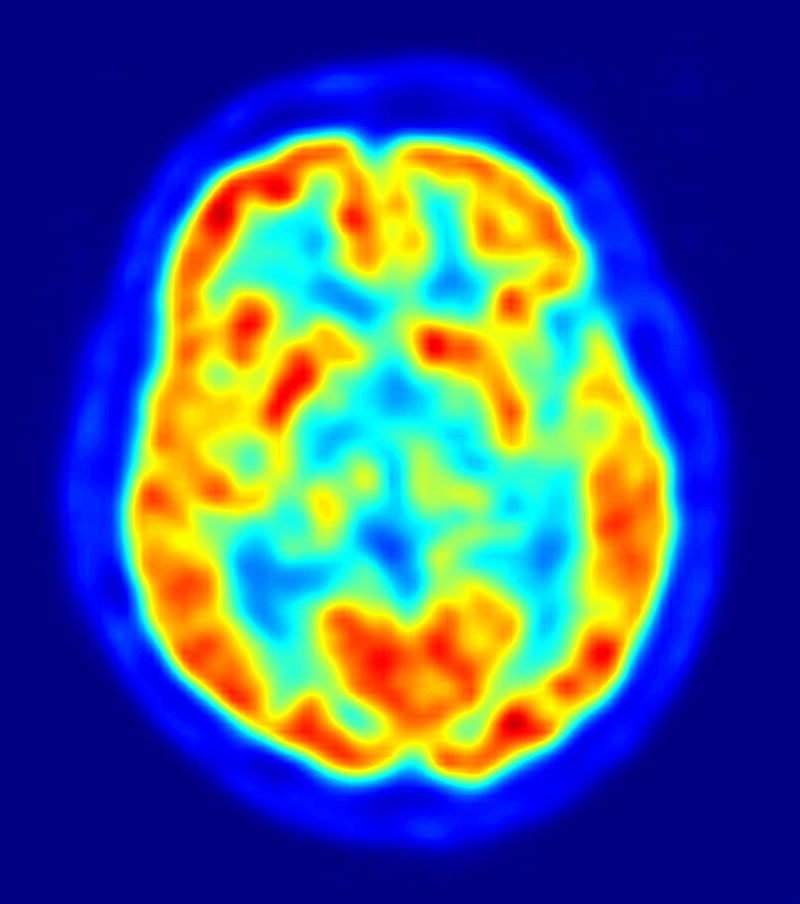 Vedere axiala a creierului la tomografie prin emisie de pozitroni.